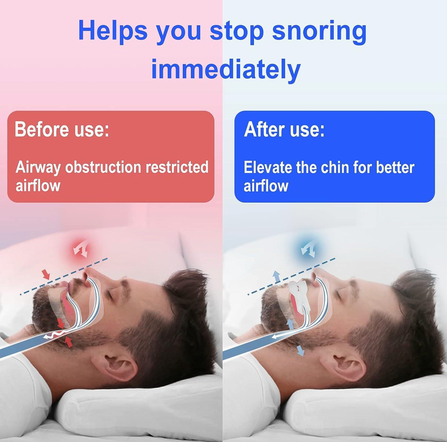 Anti-Snoring Mouth Guard – Adjustable Mouthpiece Device for Men & Women