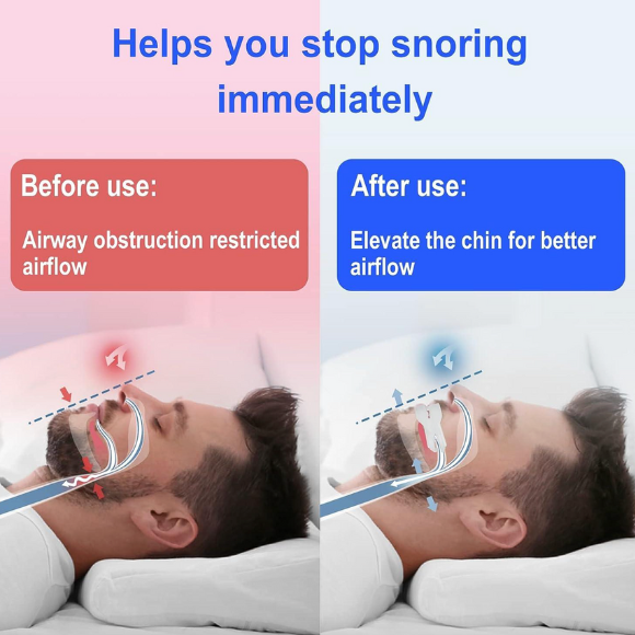 Anti-Snoring Mouth Guard – Adjustable Mouthpiece Device for Men & Women